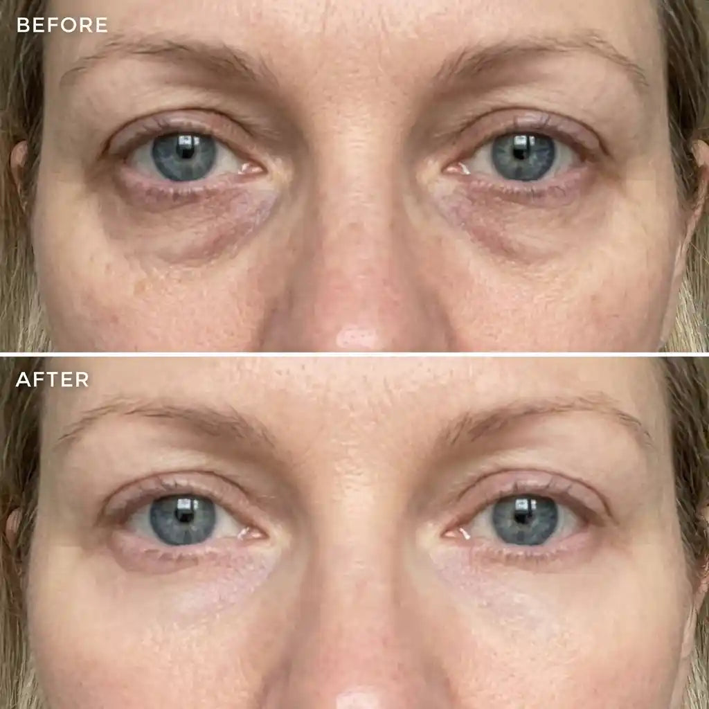 The Under-Eye Lift