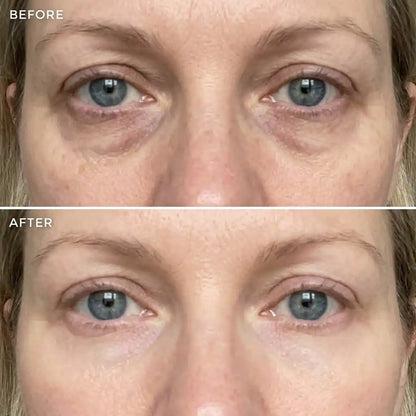The Under-Eye Lift